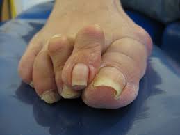 podologia geriatrica